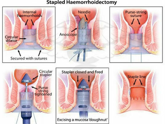 Hemorrhoids Stapler and Laser Surgery | Namo Multispecialty Hospital